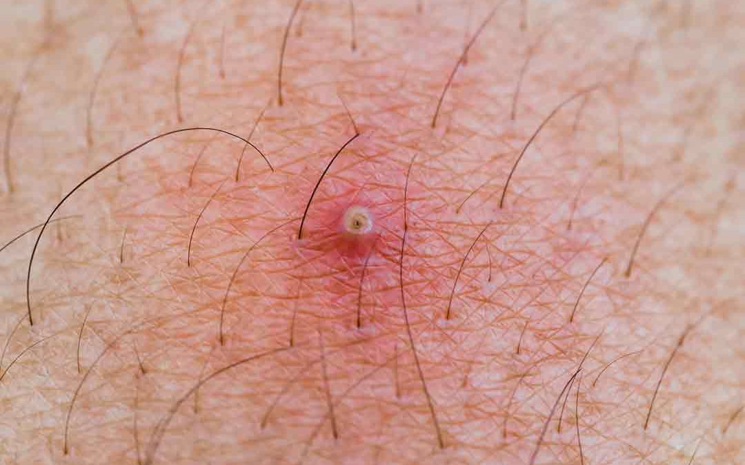 Ingrown Hair